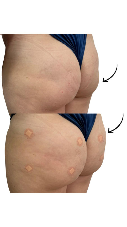 Can You Wear Tight Clothes After a Brazilian Bum Lift?